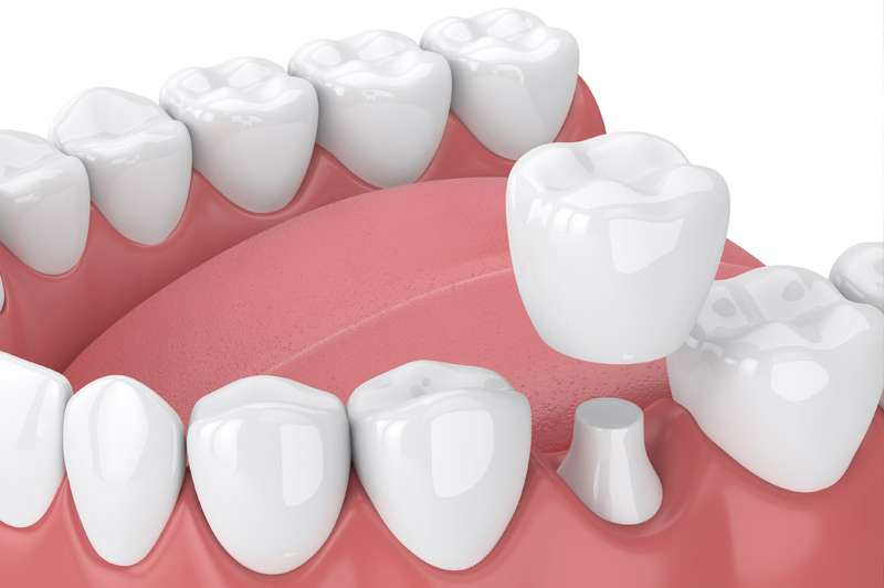 Dental Crowns in Reseda